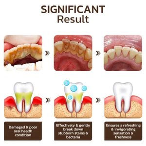 Dentifrice blanchissant probiotique Gestion de la santé bucco-dentaire(Élimine des années de taches)